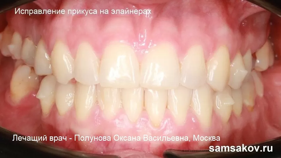 Имплантация и протезирование зубов, если в 27 лет у пациента уже мезиальный прикус. Врач-ортодонт Полунова Оксана Васильевна
