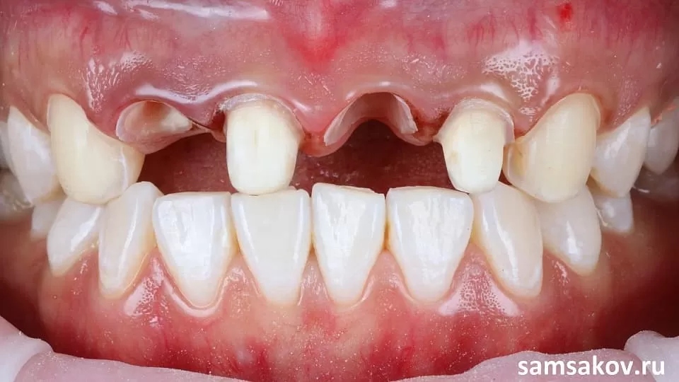 Вид до реставрации передних зубов