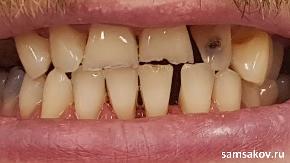 Так выглядели зубы у мужчины до установки виниров
