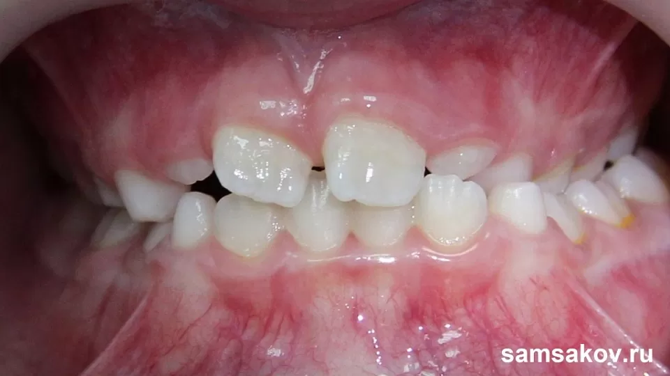 Диагноз - мезиальный прикус, сужение зубных рядов, обратное перекрестное перекрытие зубов
