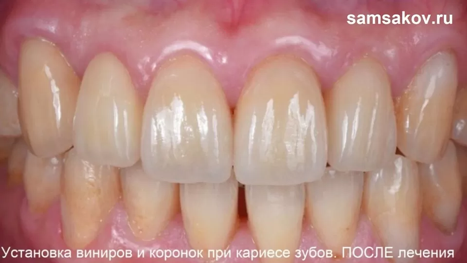 Пример, как кариозные зубы спасли винирами и коронками