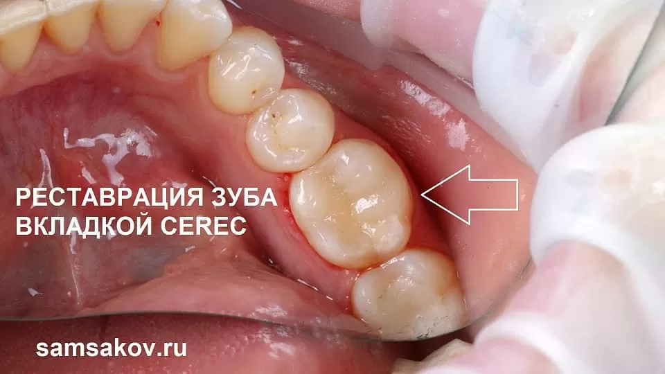 Реставрация поверхности жевательного зуба 3.6 вкладкой CEREC - клиника Cerecon, ортопед Сергей Самсаков
