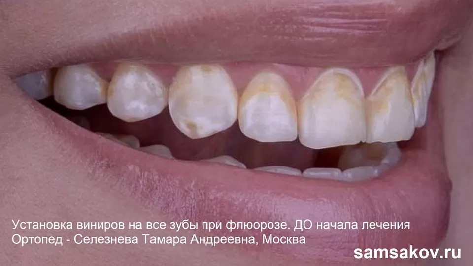 От чего возникают пятна на зубах, что такое флюороз и как его полностью устранить