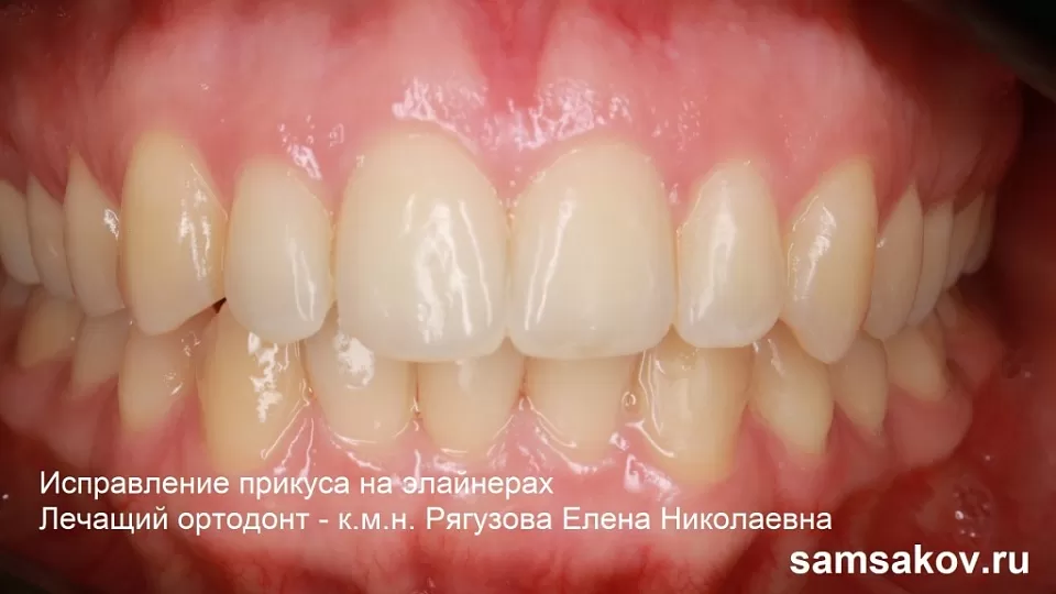 Сужение зубных рядов в 34 года можно быстро исправить элайнерами