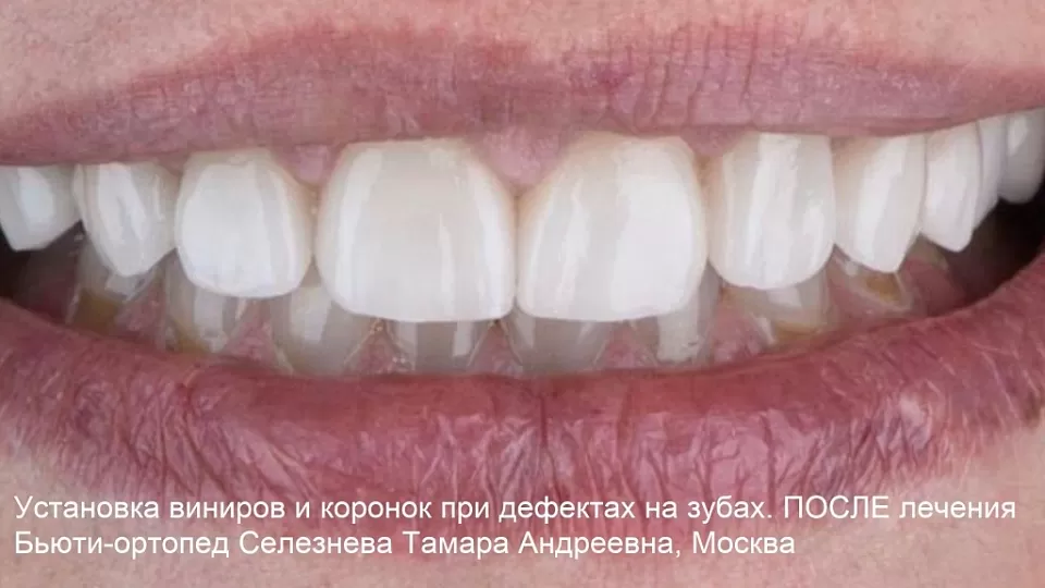 Пример лечения клиновидного дефекта и пришеечного кариеса на передних зубах винирами