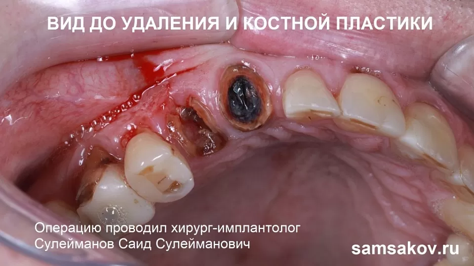 Потерянный по вине пациента зуб. Случай, когда его можно было спасти и восстановить. Лечение проводил хирург-имплантолог Сулейманов Саид Сулейманович
