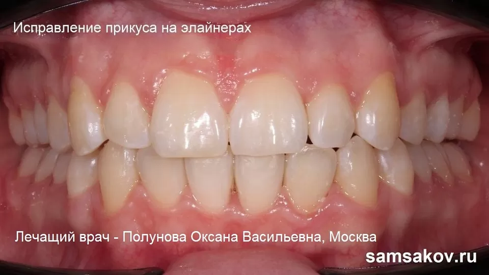 Капы для выравнивания зубов бывают гораздо лучше брекетов, если у пациента повернутые зубы. Врач - Полунова Оксана Васильевна