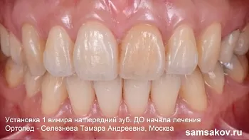 Винир на 1 передний зуб как пример красивой эстетики и экономии в лечении