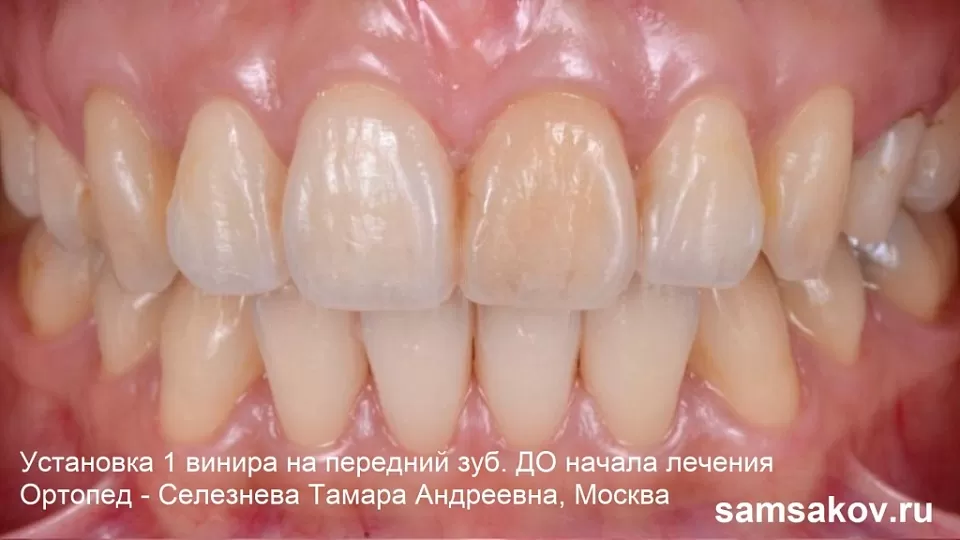 Винир на 1 передний зуб как пример красивой эстетики и экономии в лечении. Врач - Селезнева Тамара Андреевна, Москва