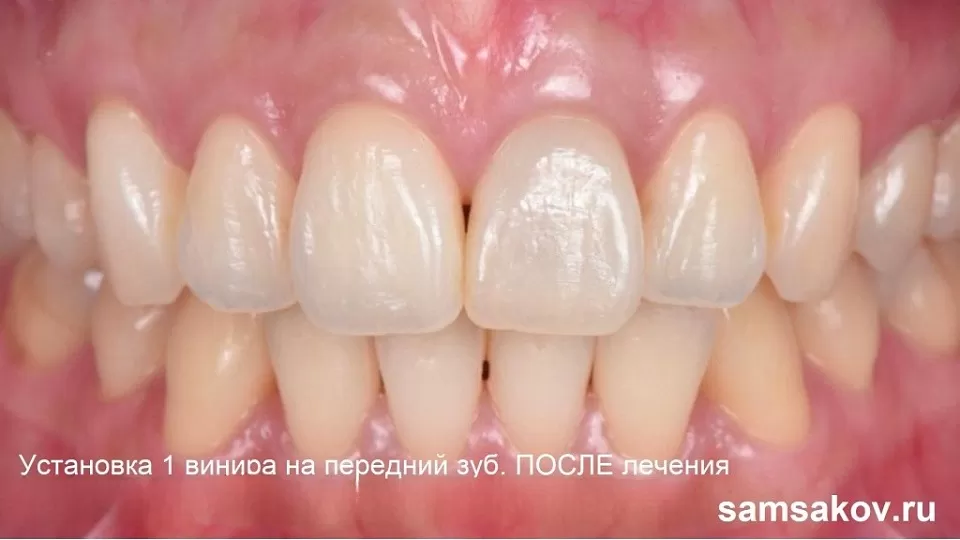 Как всего 1 винир на 1 зуб помог вернуть красивую улыбку пациентке. Ортопед Тарасов Алексей Анатольевич, Москва