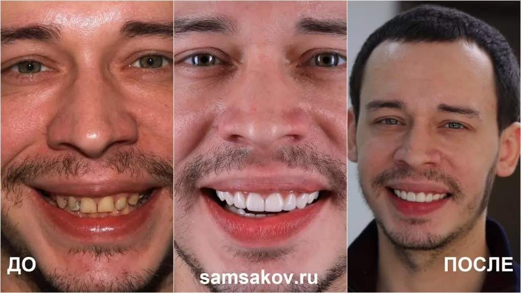 Фото Виталия до и после установки виниров