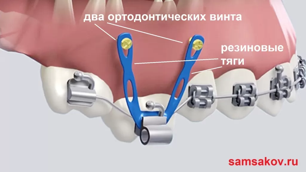 Винт ортодонтический - это один из инструментов, используемых в ортодонтии для коррекции положения зубов и прикуса.