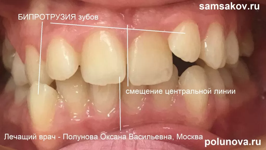Бипротрузия зубов, смещение центральной линии вправо. Вид до начала лечения на брекетах Даймон Клир