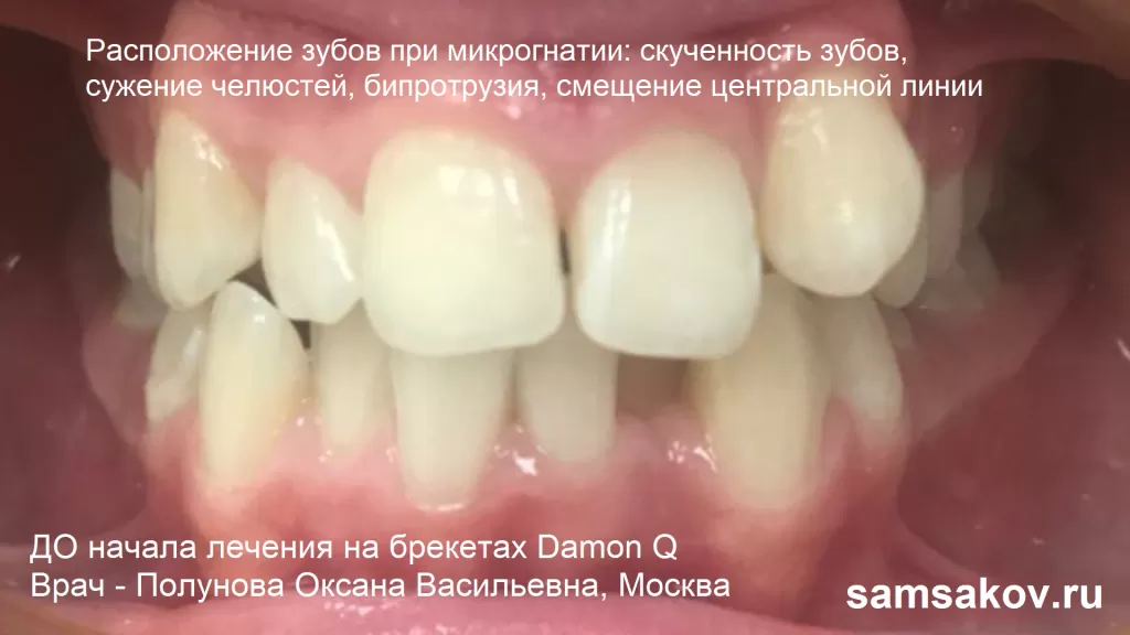 Микрогнатия - нарушение в развитии зубов, проявляющееся в скученности зубов, сужении челюстей, бипротрузии, смещении центральной линии