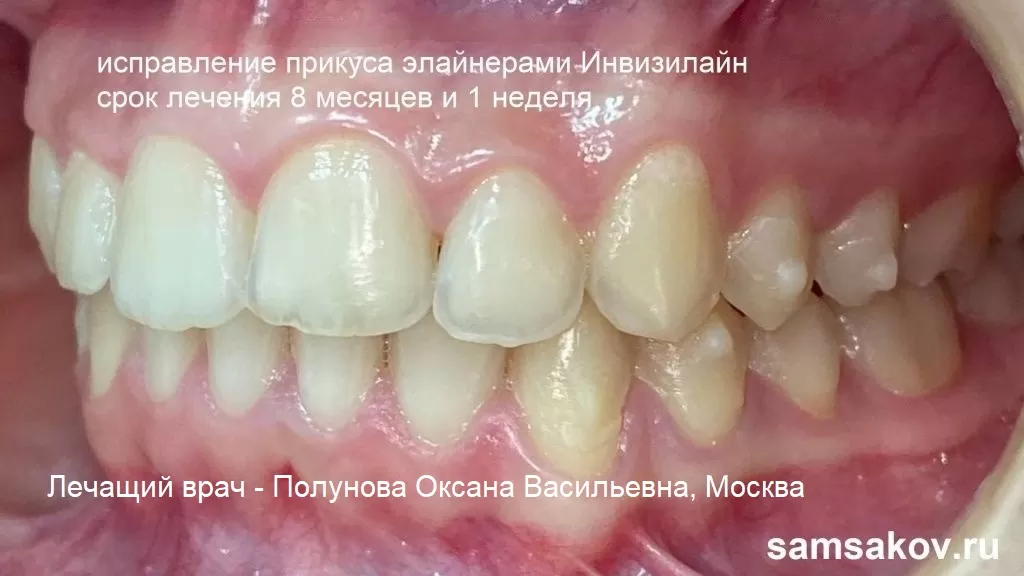 Фото правильных контактов зубов после лечения на элайнерах для подростков. Врач - Полунова Оксана Васильевна, Москва