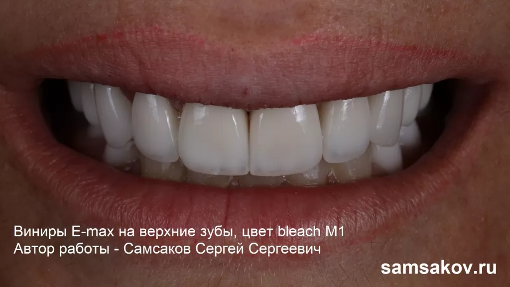 Виниры на вержние передние зубы. Автор работы - Самсаков Сергей Сергеевич