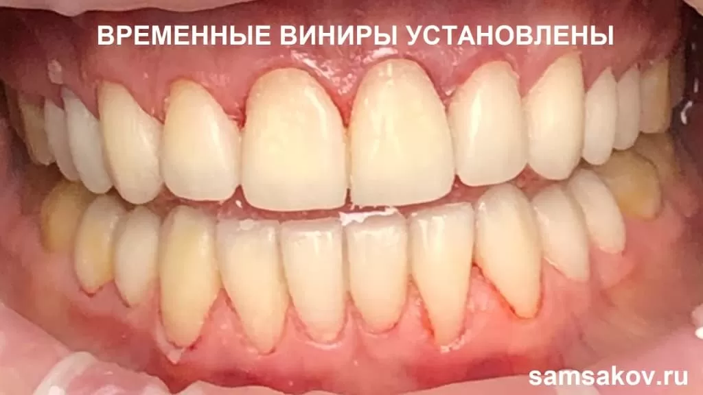Временные виниры установлены. Работа стоматолога-ортопеда Самсакова Сергея 