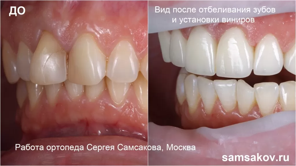 Отбеливание зубов. Цвет поменялся с желтого на 1М1