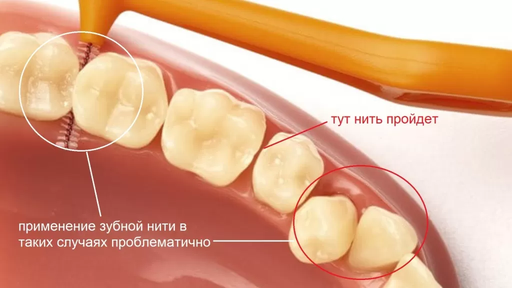 при скученности зубов нить не проходит в межзубные пространства, и как раз в таких случаях ершики - идеально решение