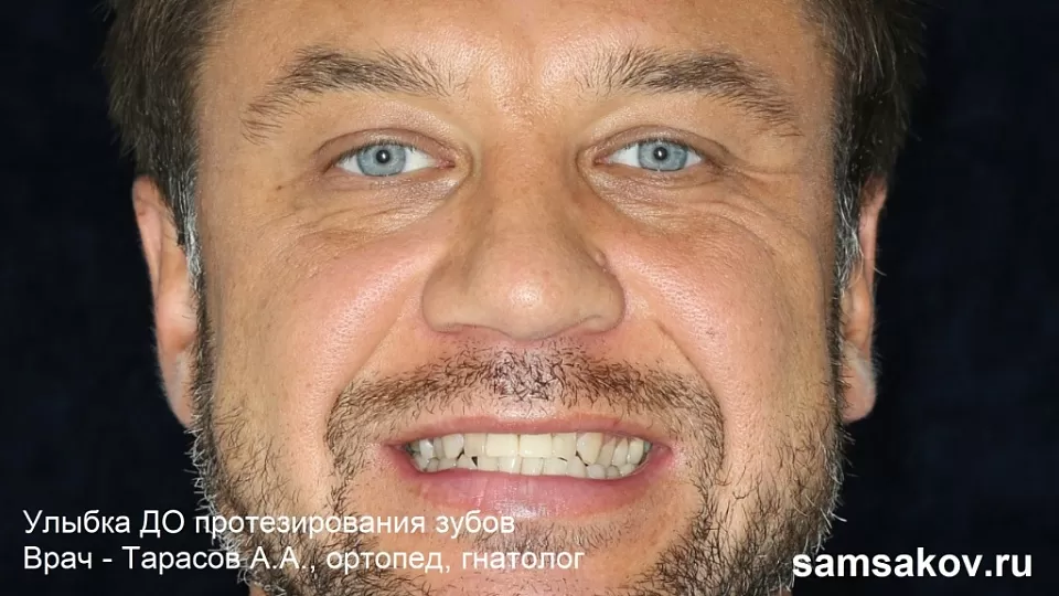 Так выглядела мужская улыбка до начала протезирования зубов. Лечащий ортопед - Тарасов Алексей Анатольевич, Москва  