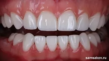 Как виниры успешно скрыли последствия глубокого кариеса на зубах